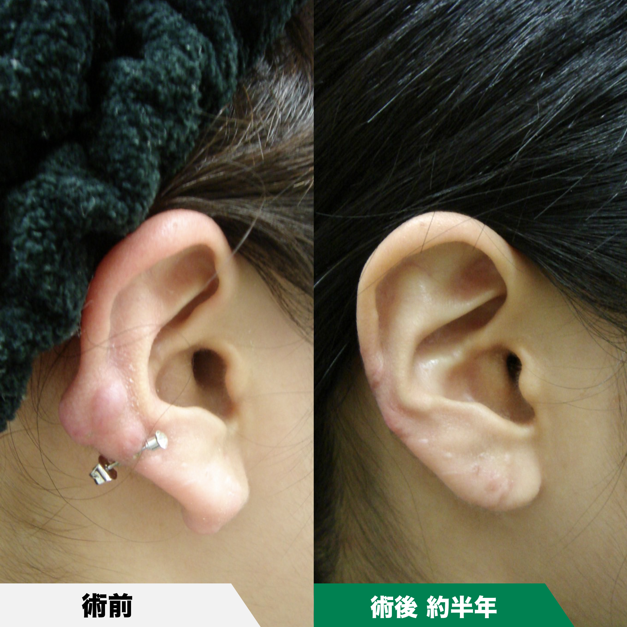 耳（耳垂裂 じすいれつ）の手術の術後経過 | 神楽坂肌と爪のクリニック